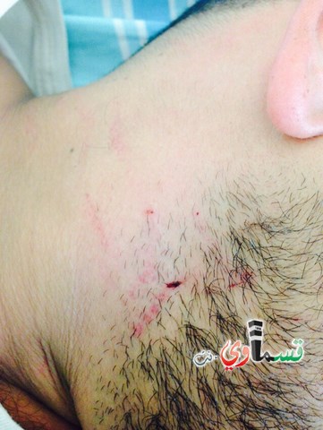 حيفا: قطعان من المتطرفين اليهود يعتدون على الشاب آدم الفقير (25 عاما) من قرية ابطن،